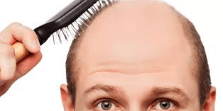 Types of hair loss